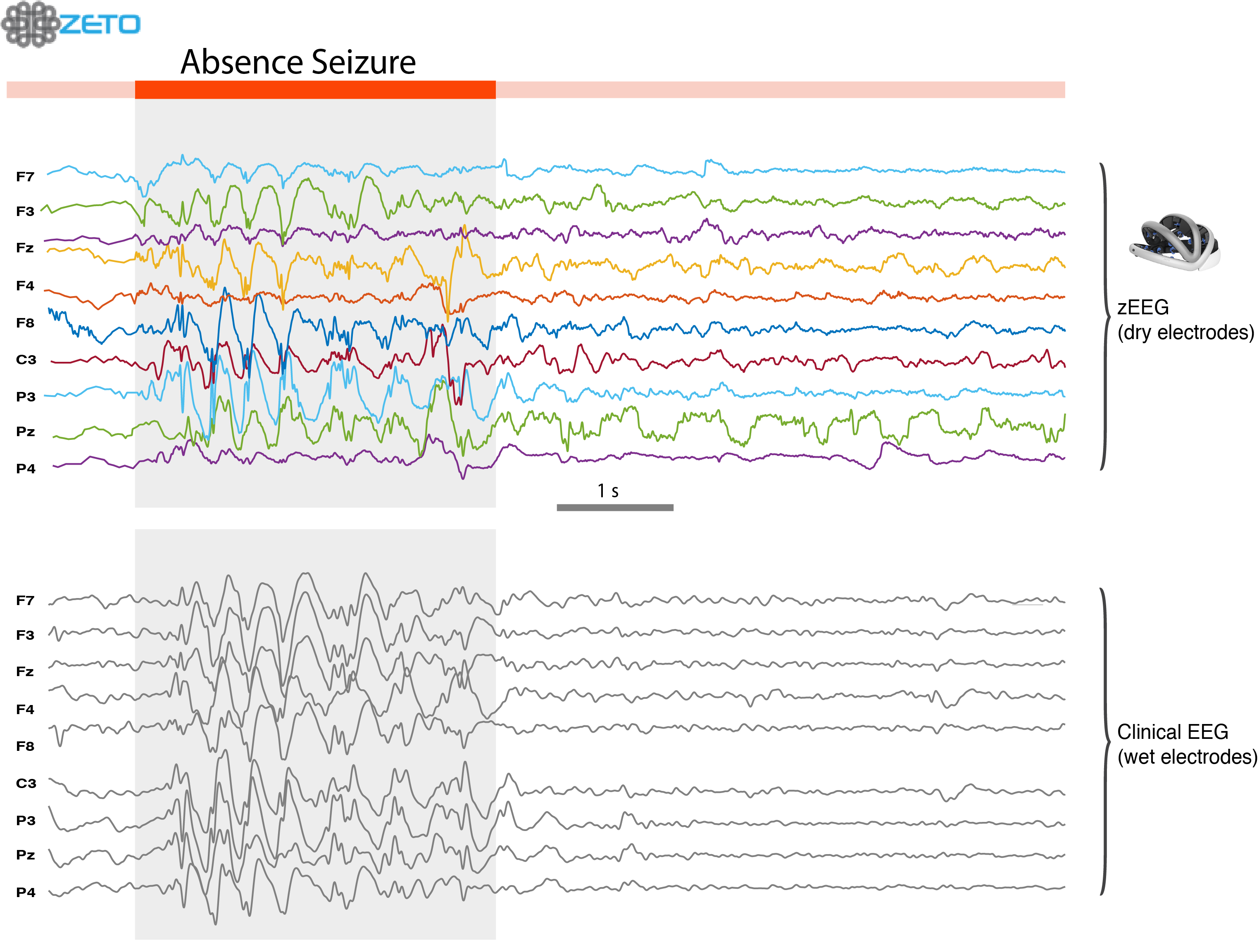 eeg absence seizure eeg absence seizure