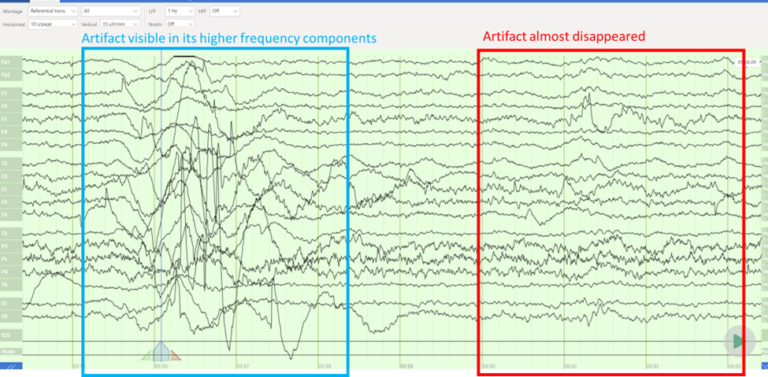 Managing EEG Sweat Artifact | ZETO