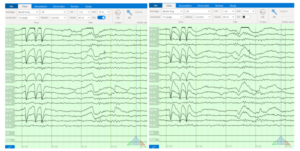 How Digital EEG Filters Impact EEG Signal Morphology | Zeto EEG