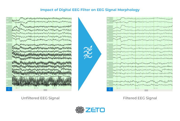 How Digital EEG Filters Impact EEG Signal Morphology