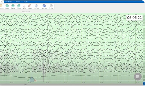Man monitored with Zeto EEG and video in hospital bed