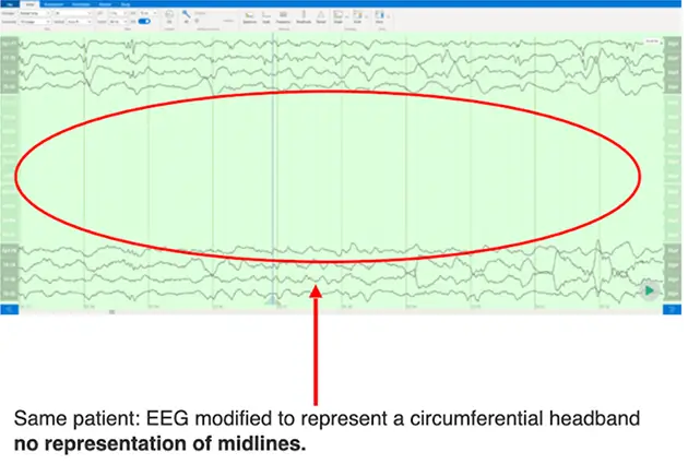 partial-EEG-image